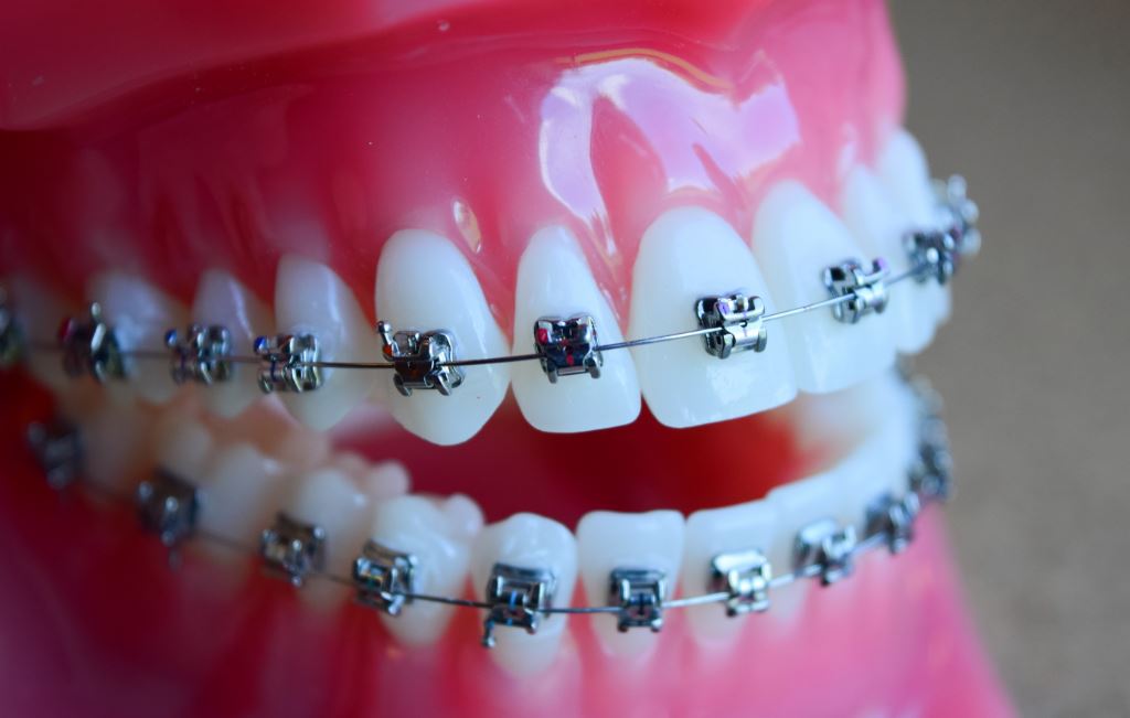 self-ligating braces